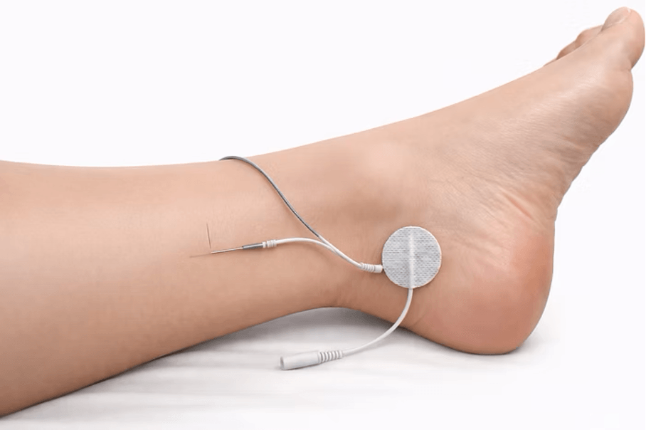PTNS behandeling: Naald en elektrode op de enkel voor percutane tibiale zenuwstimulatie bij overactieve blaas.