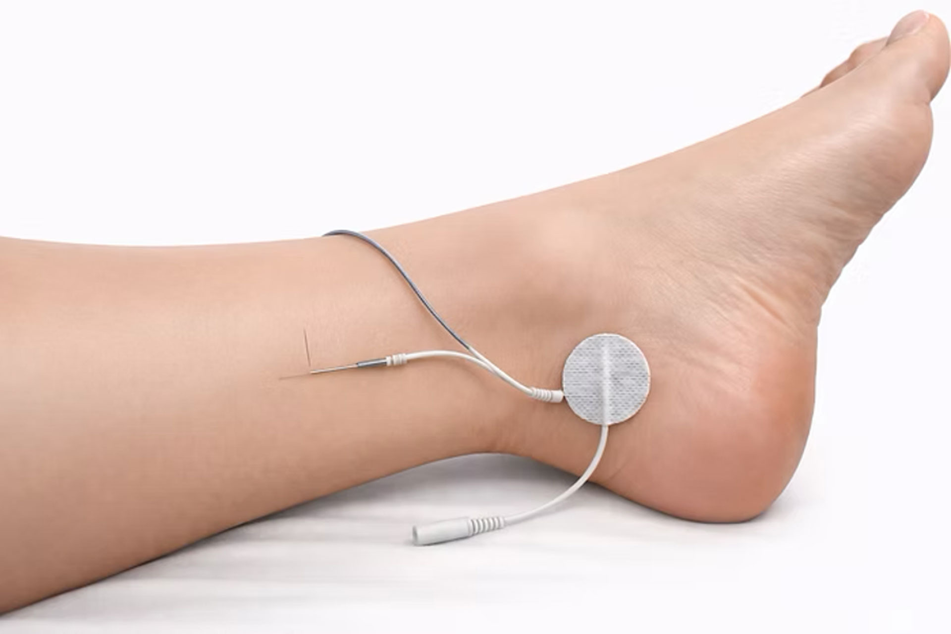 PTNS behandeling: Naald en elektrode op been voor percutane tibiale zenuwstimulatie.